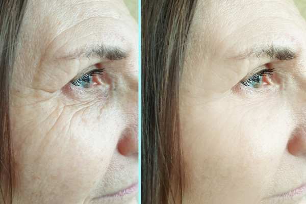 Why Do People Choose HIFU for a Non-Surgical Facelift? 4 How long can HIFU results last Biggleswade?