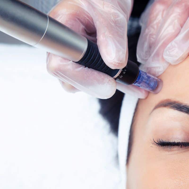 Morpheus8 treatment Biggleswade from Lipo Sculpt - Book in today!