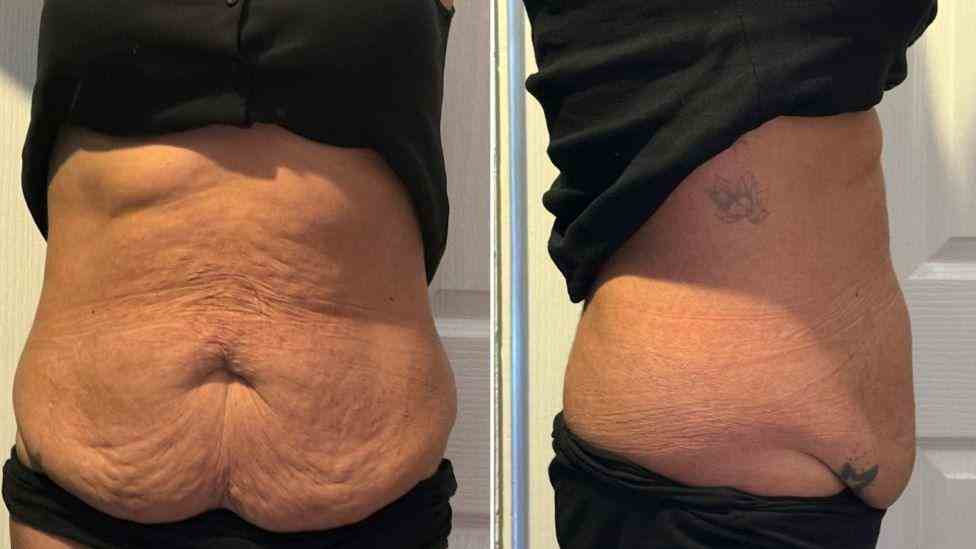 Lost the Weight but Not the Loose Skin? What You Should Know 1 Is It Definitely Loose Skin Biggleswade?